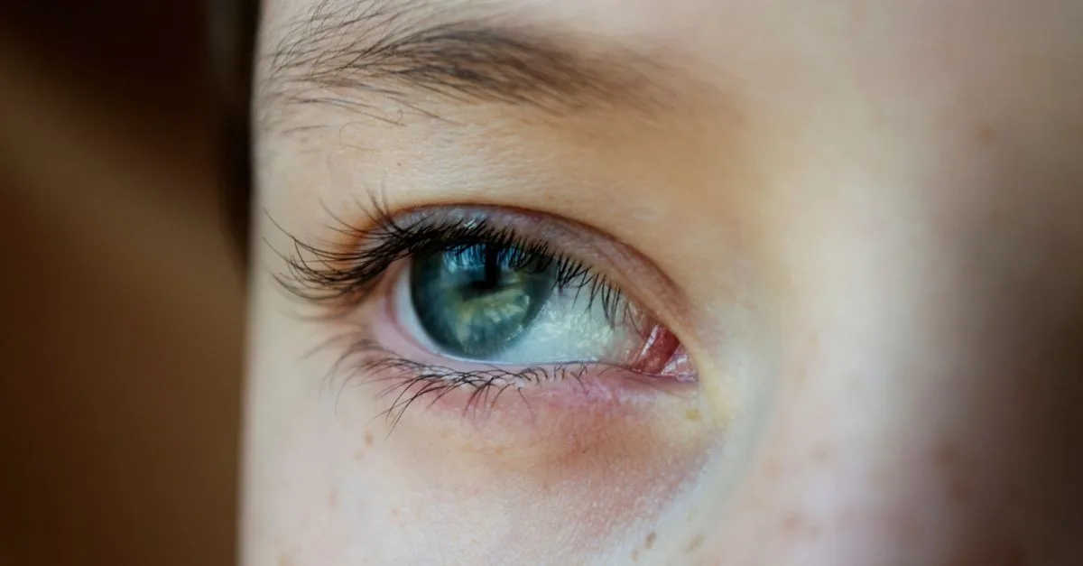 découvrez des solutions efficaces pour les problèmes de peau autour des yeux, incluant irritations, boutons et autres troubles cutanés spécifiques à cette zone délicate.